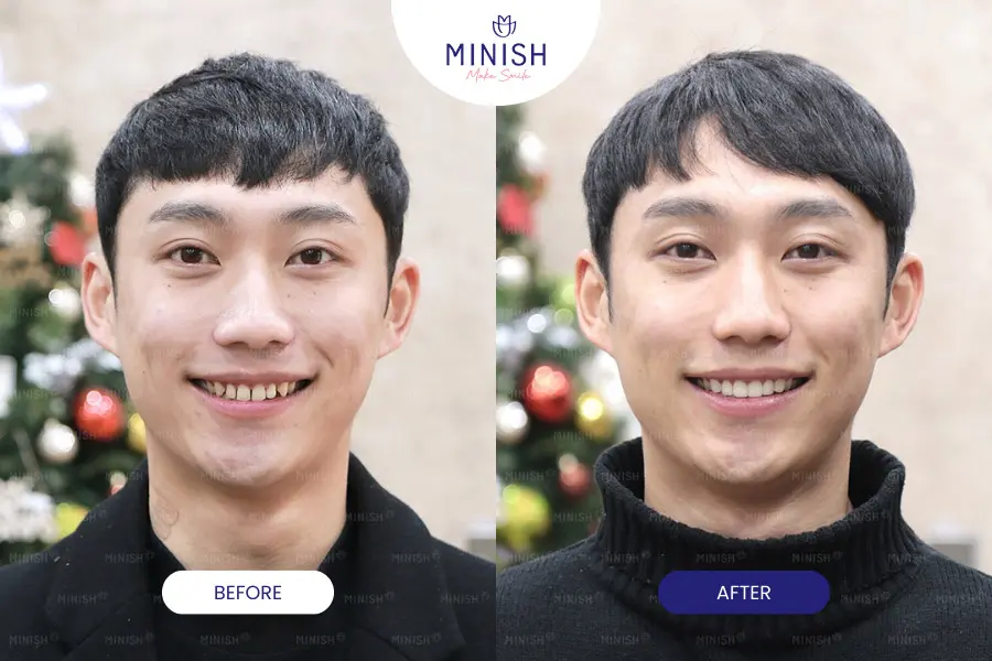 Before and After